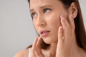 Adult Acne Treatment_ Causes and Clear Skin Solutions