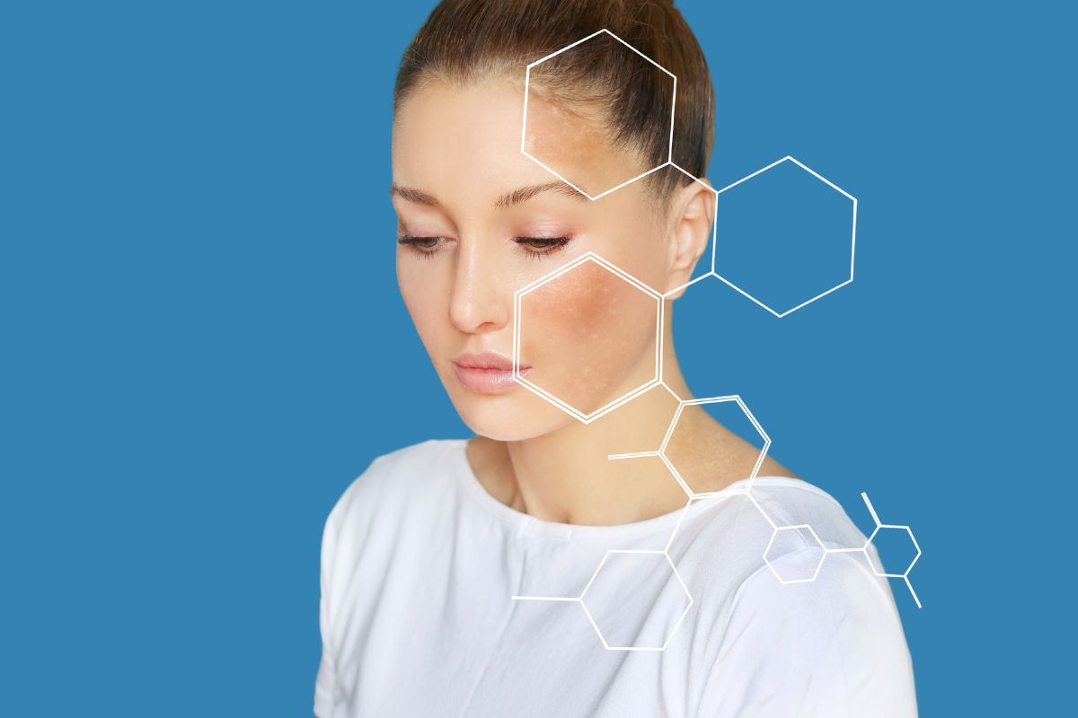 Why Adult Acne Requires a Different Treatment Approach