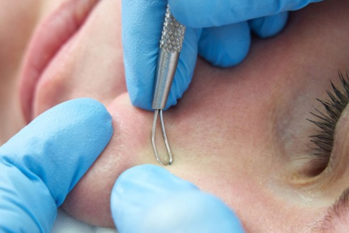 Professional Adult Acne Treatment in Florence, KY