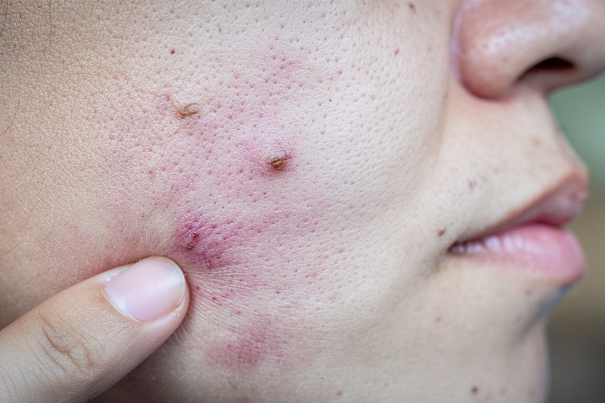 When It Is Time to See an Acne Specialist