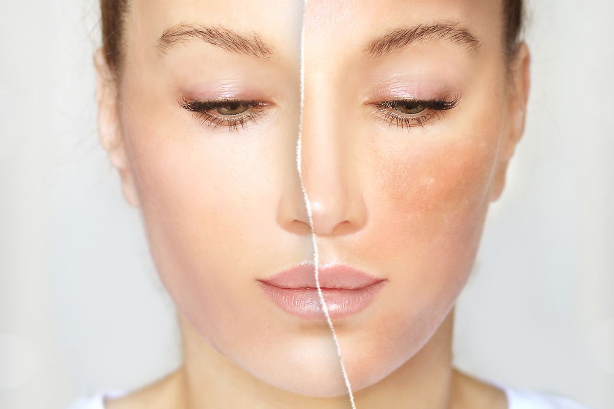 Clear Skin Is Possible at Any Age