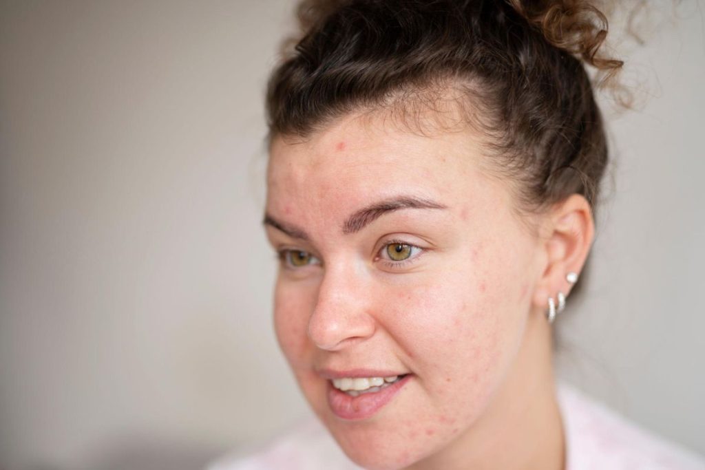 acne not improving despite skincare routine Florence KY