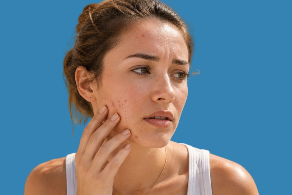 Summer acne flare-ups becoming more noticeable during hot and humid weather