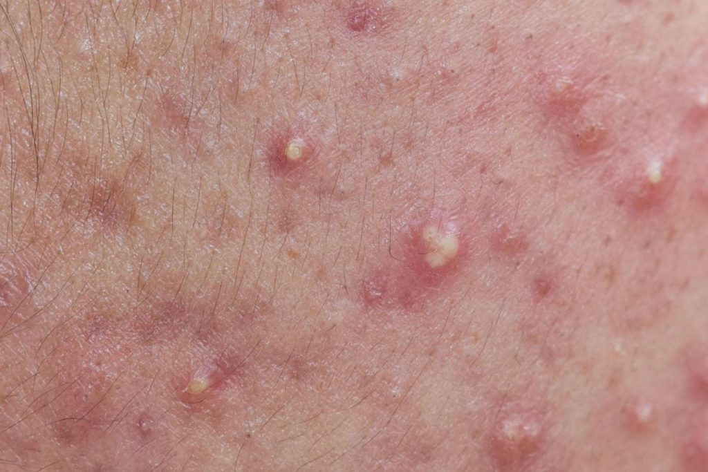 why acne skincare routine not working clogged pores texture