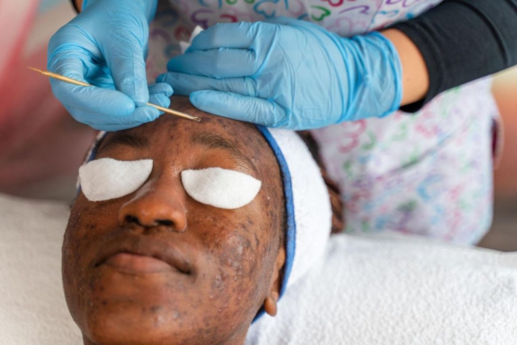 professional acne facial extraction treatment Florence KY