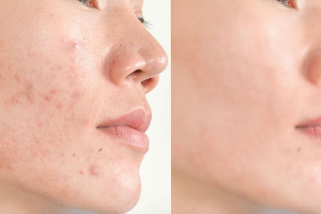 acne healing progress smoother skin reduced breakouts
