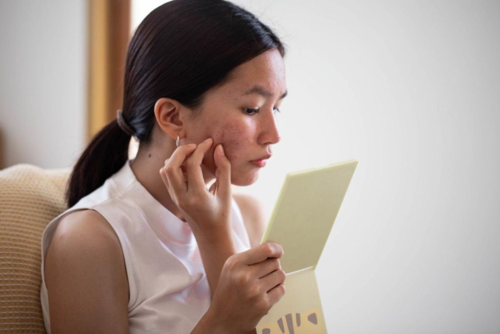 persistent acne chin breakouts hormonal acne concern